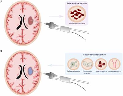 New Mechanistic Insights, Novel Treatment Paradigms, and Clinical Progress in Cerebrovascular Diseases